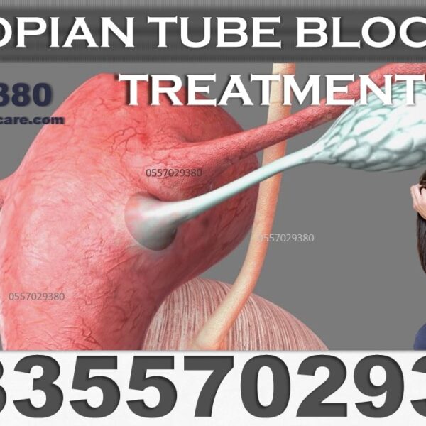 Best Blocked Fallopian Tubes Natural Treatment in Ghana