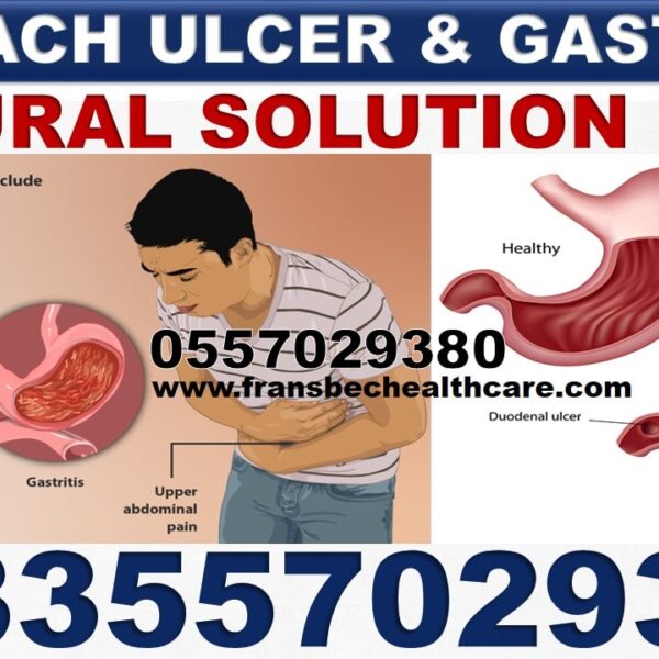 Natural Medicine for Gastritis in Ghana