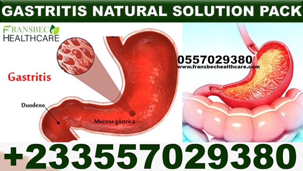 Best Gastritis Natural Supplements in Ghana