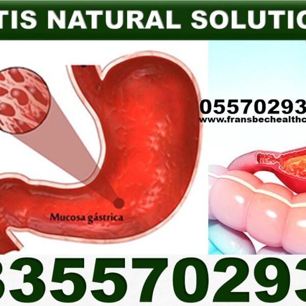 Best Gastritis Natural Supplements in Ghana