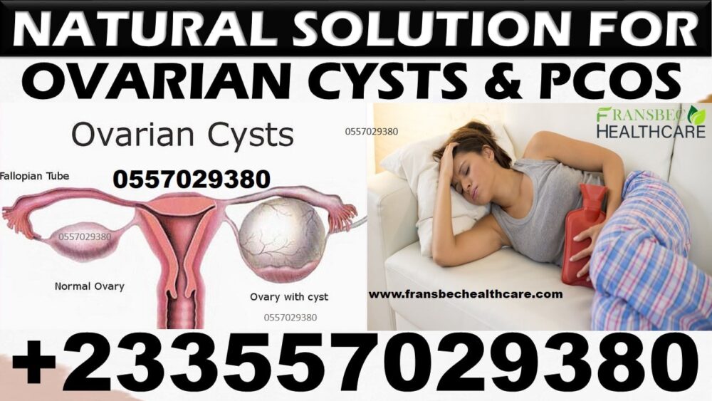 Best Ovarian Cyst Natural Treatment in Ghana