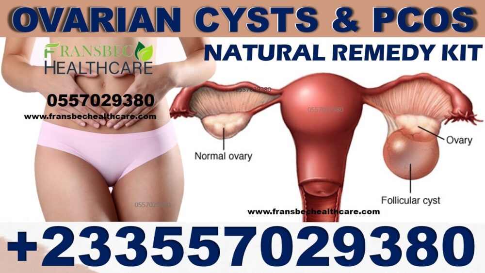 Best Ovarian Cyst Natural Supplements in Ghana