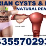 Best Ovarian Cyst Natural Supplements in Ghana