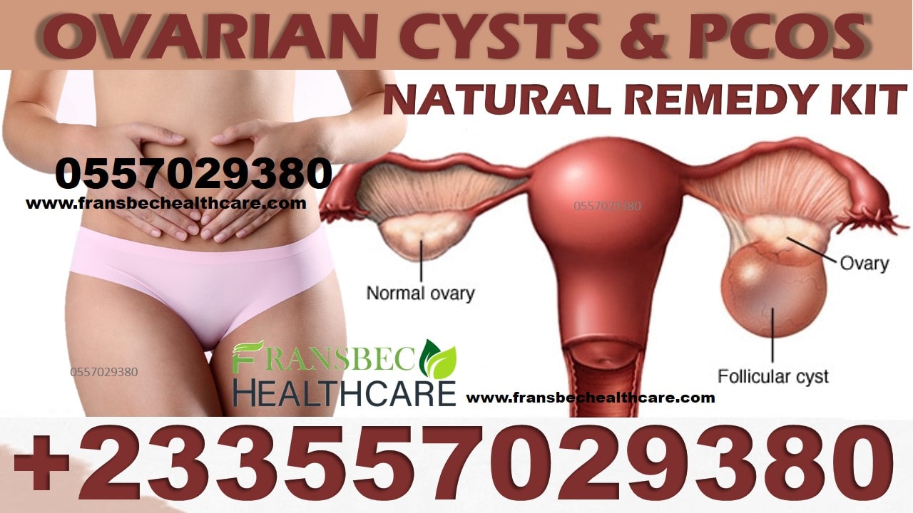 Best Ovarian Cyst Natural Products in Ghana