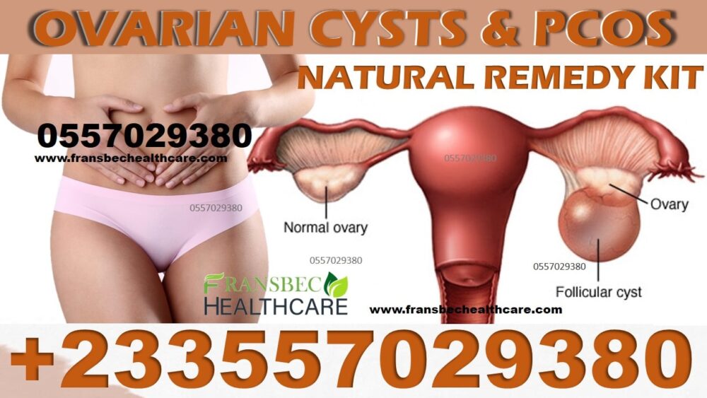 Best Ovarian Cyst Natural Treatment in Ghana