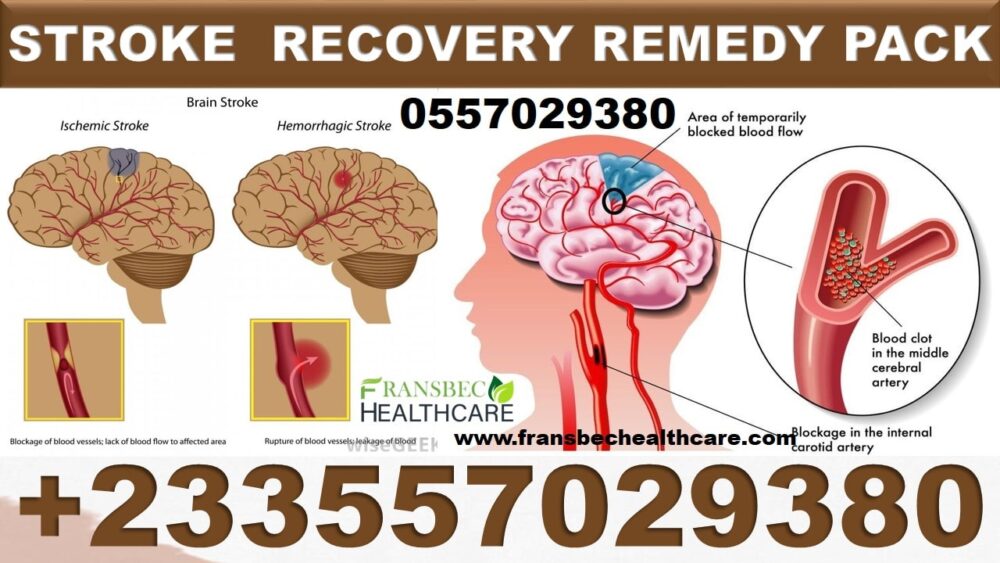 Best Treatment for Stroke in Ghana