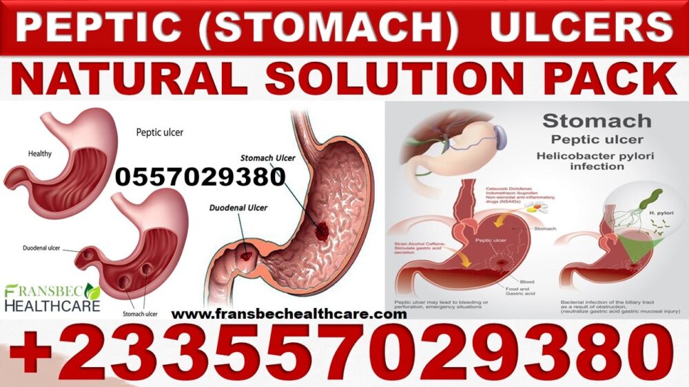 Forever Natural Products for Stomach Ulcer