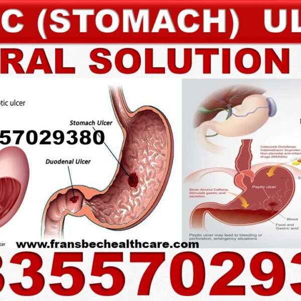 Best Gastric ulcer Natural Supplements in Ghana