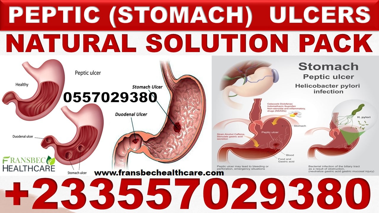 Stomach Ulcer Natural Care