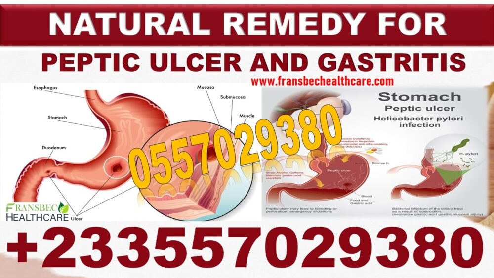 Best Gastric ulcer Natural Treatment in Ghana