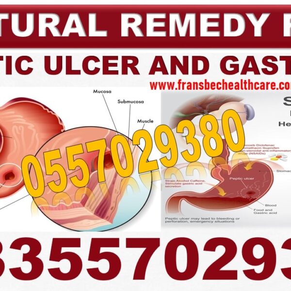 Best Gastric ulcer Natural Treatment in Ghana
